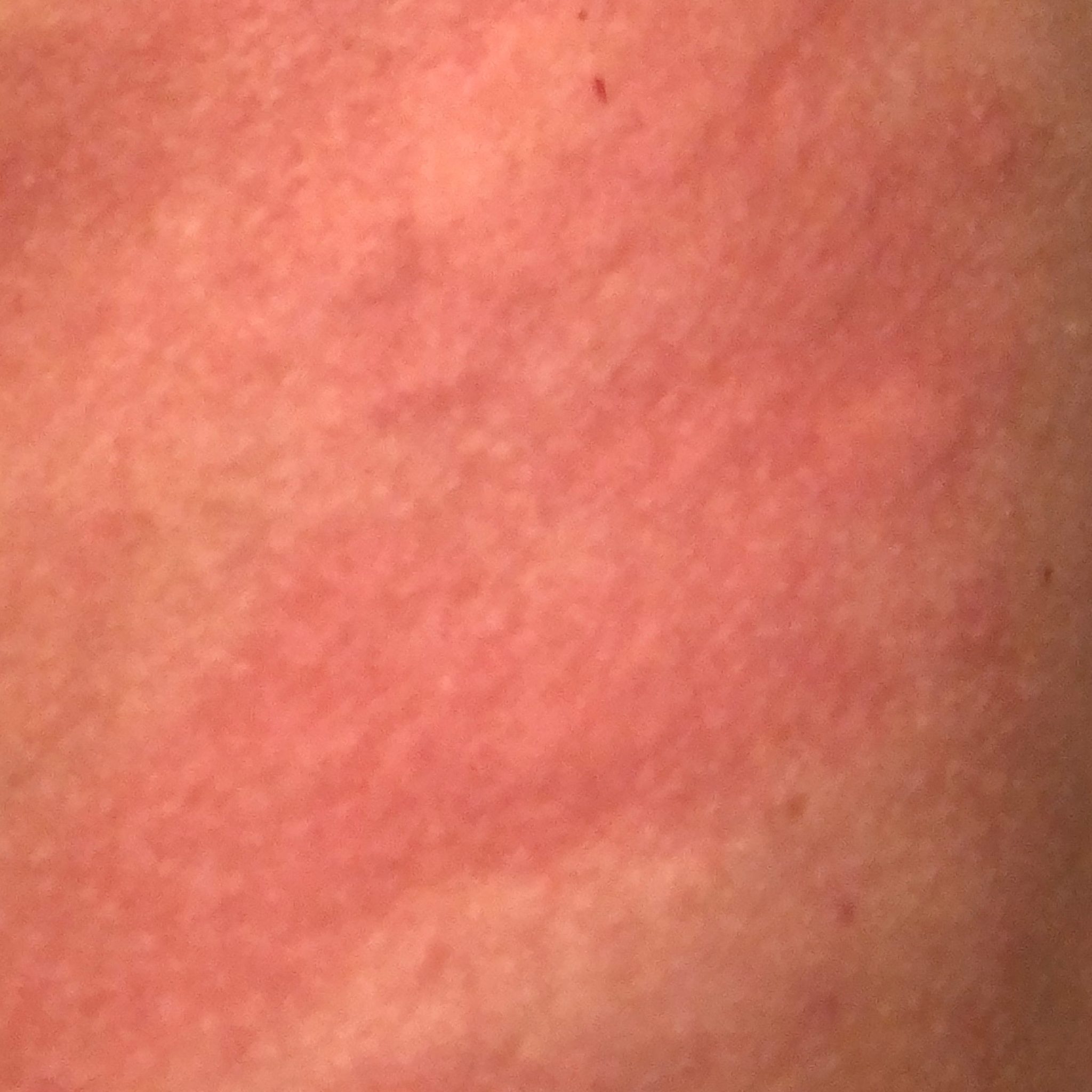 Dermatitis (ICD10 L20L30) Online AI Dermatologist