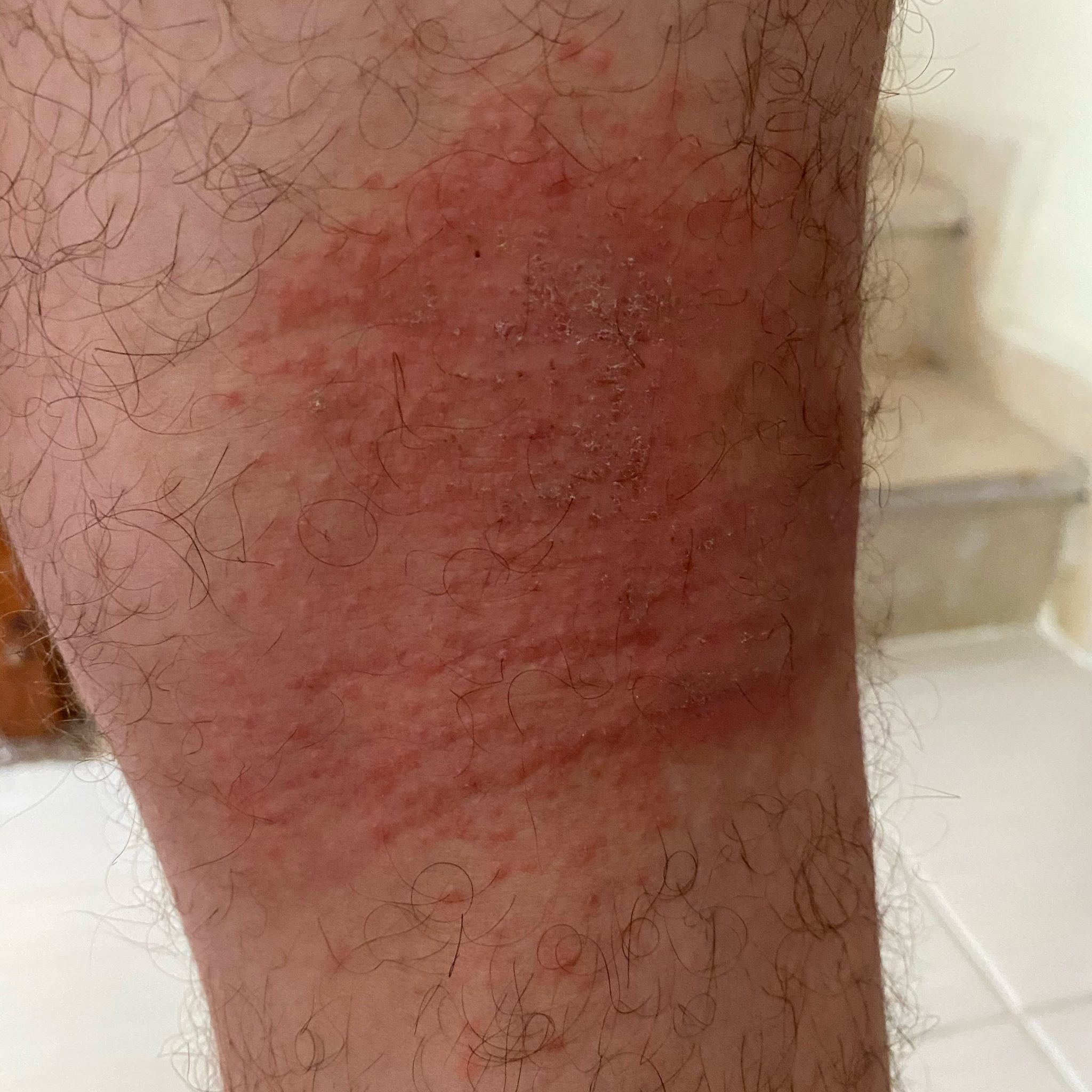 Atopic Dermatitis (ICD10 L20) Online AI Dermatologist