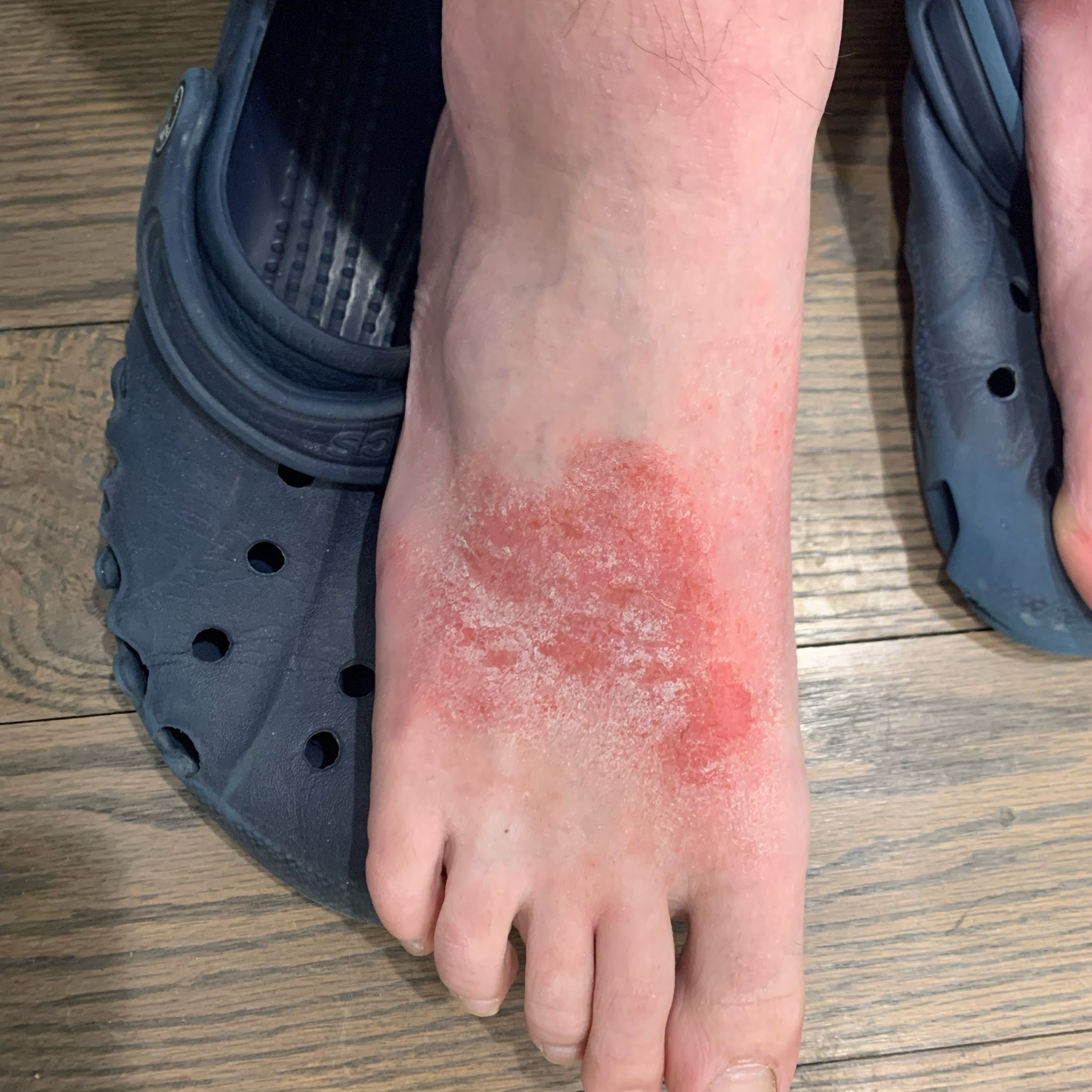 Eczema (ICD10 L20L30) Online AI Dermatologist