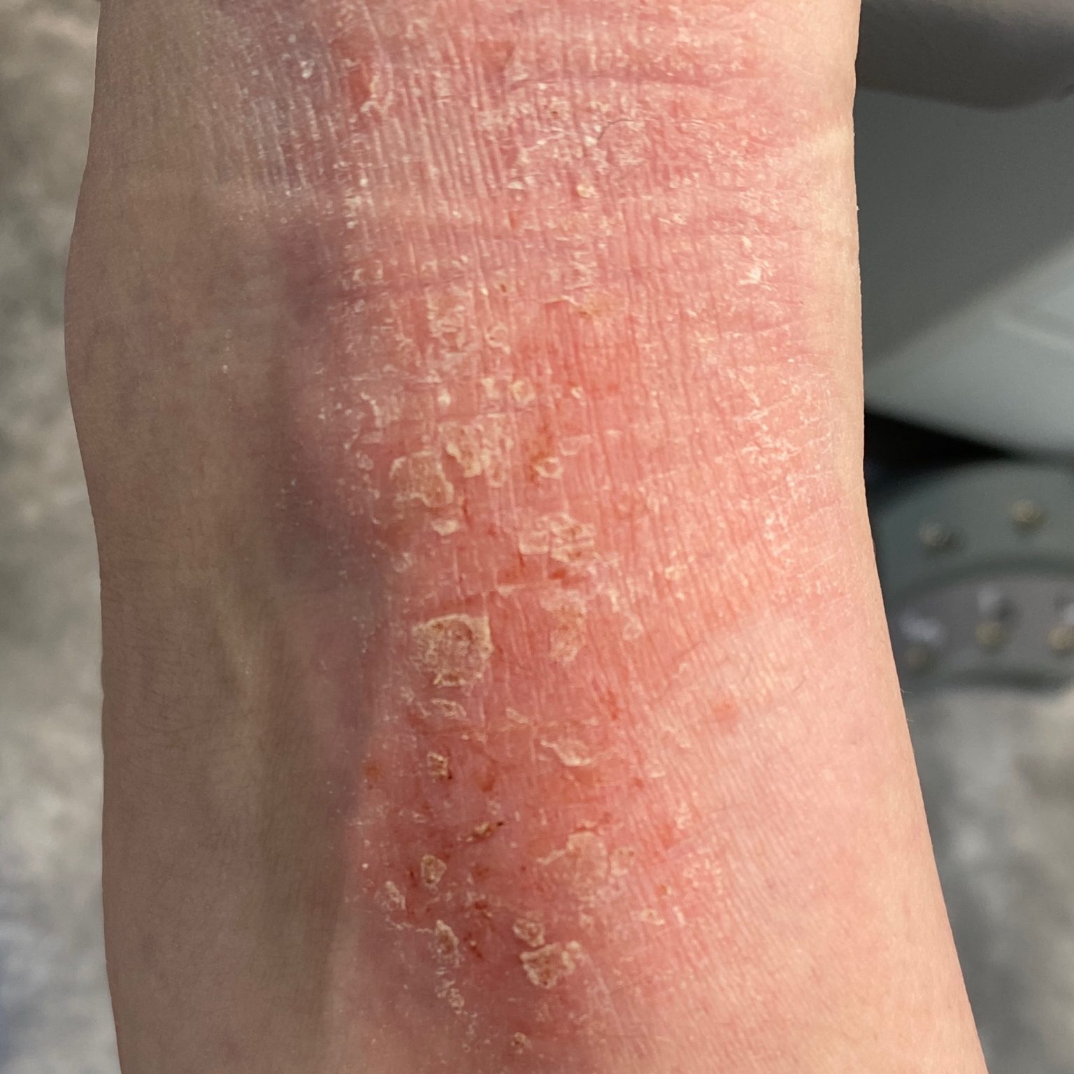 Eczema (ICD10 L20L30) Online AI Dermatologist