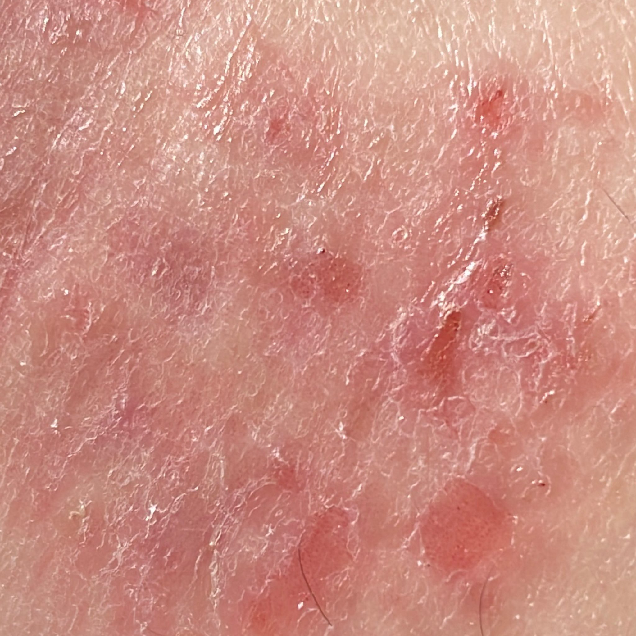 Eczema (ICD10 L20L30) Online AI Dermatologist