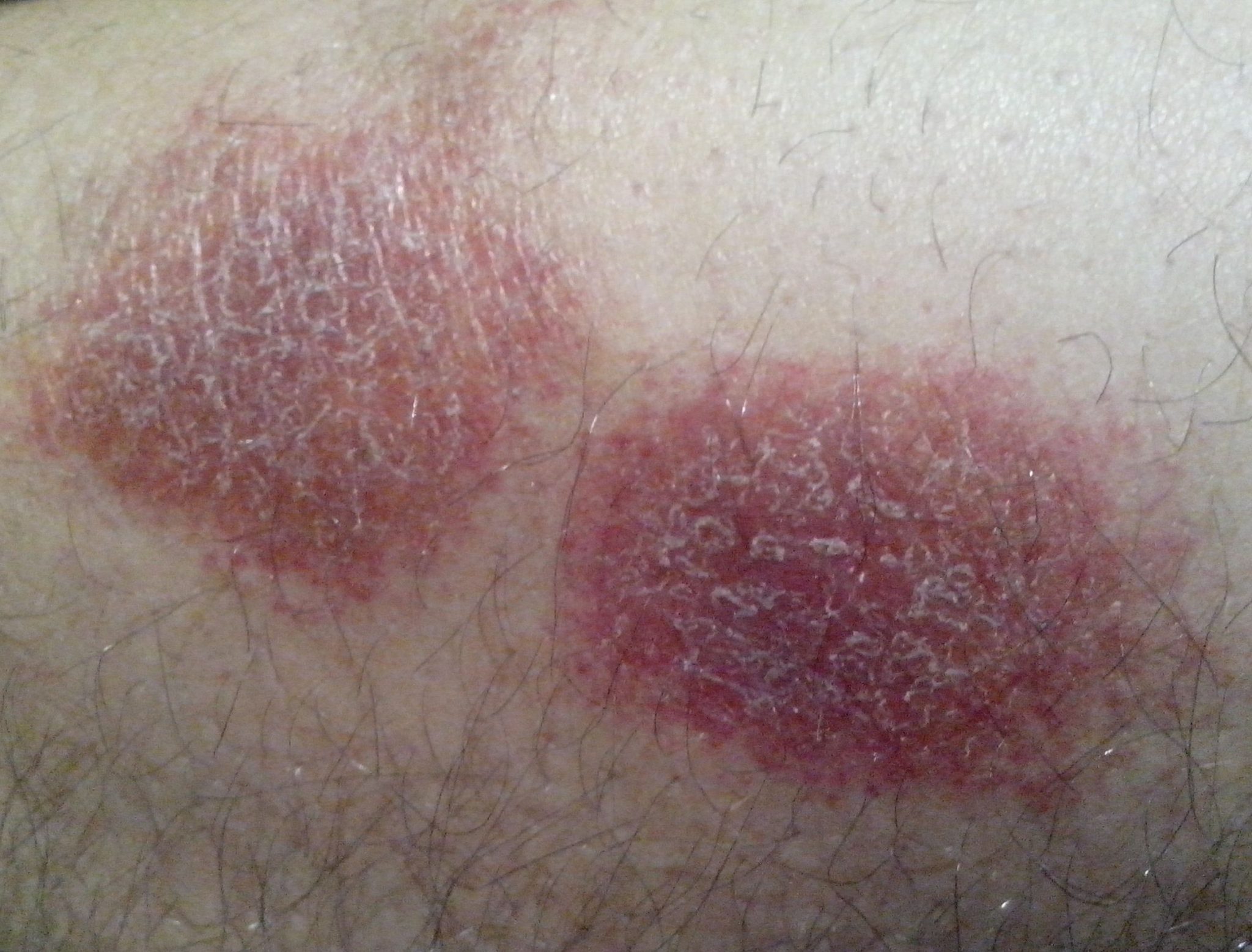 Dermatitis (ICD10 L20L30) Online AI Dermatologist