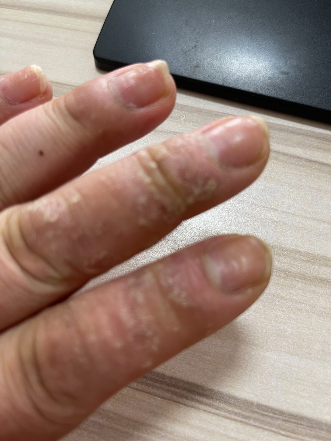 Eczema (ICD10 L20L30) Online AI Dermatologist