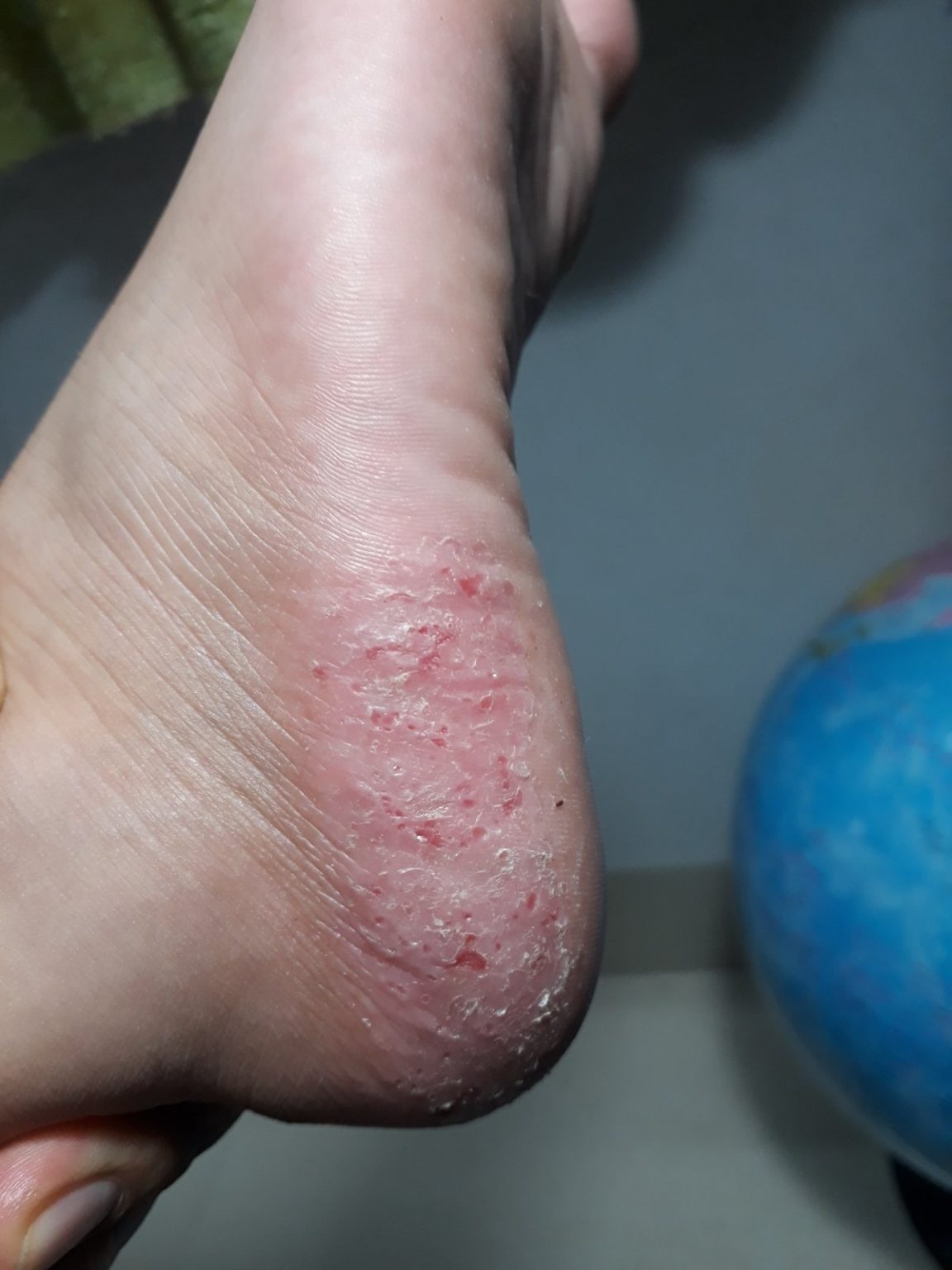 Eczema (ICD10 L20L30) Online AI Dermatologist