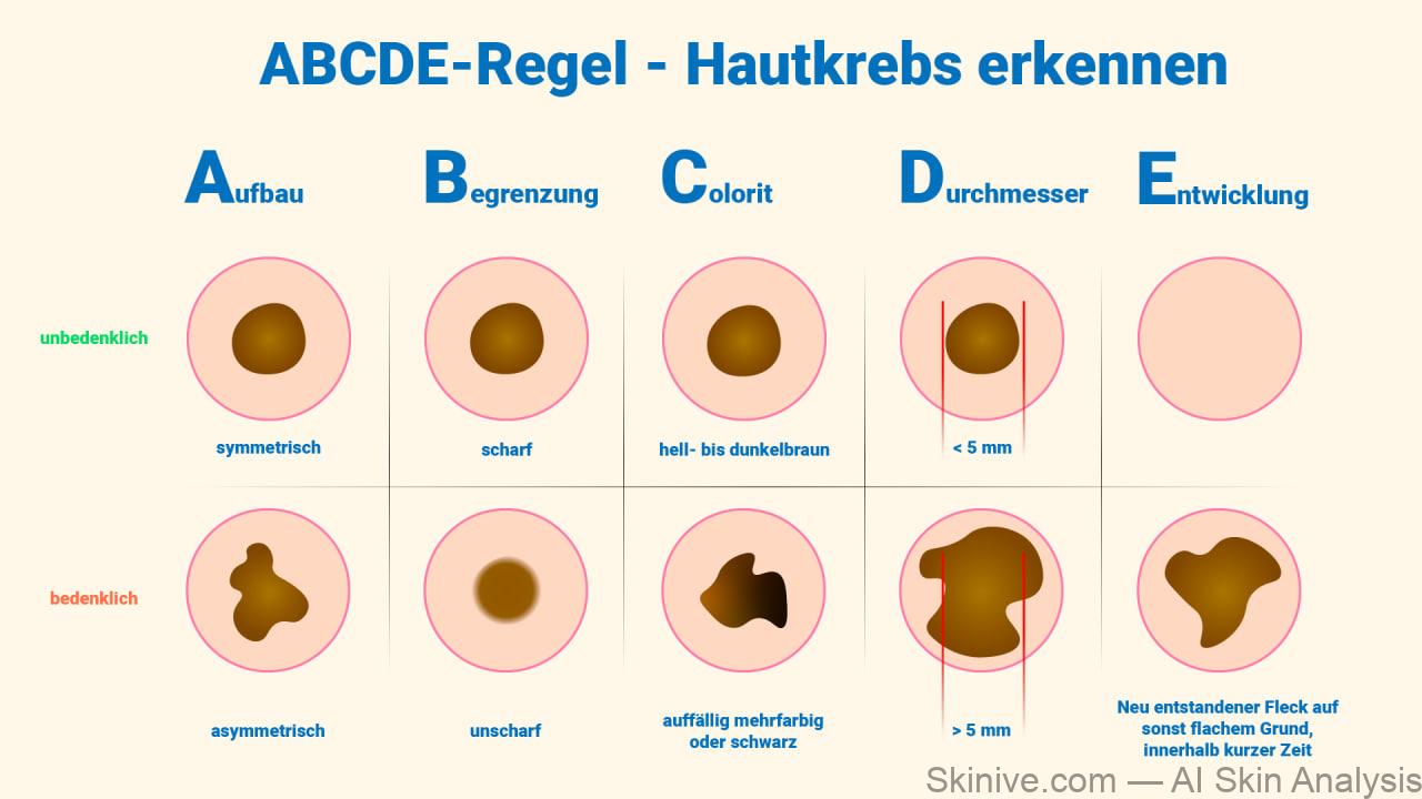 Hautkrebs-ABCDE-Regel
